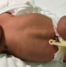 baby with an abdominal separation