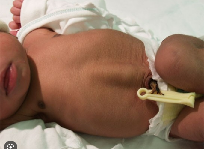 baby with an abdominal separation